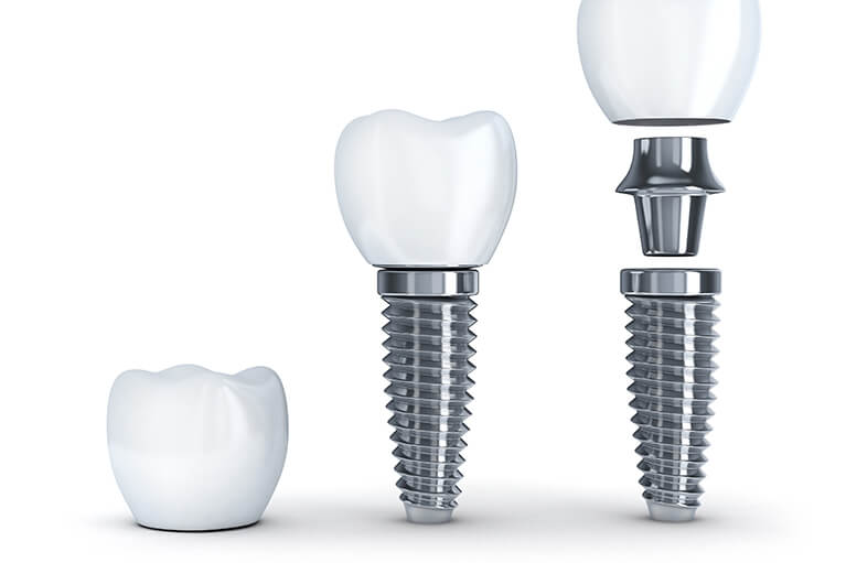 インプラント治療とは